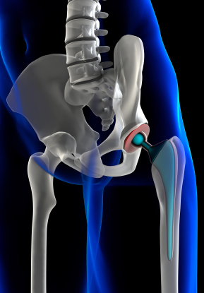 Stryker hip implant lawusit